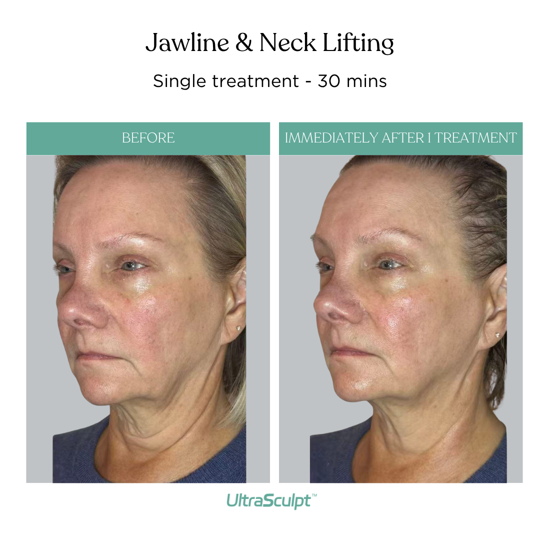 Jawline and neck — before