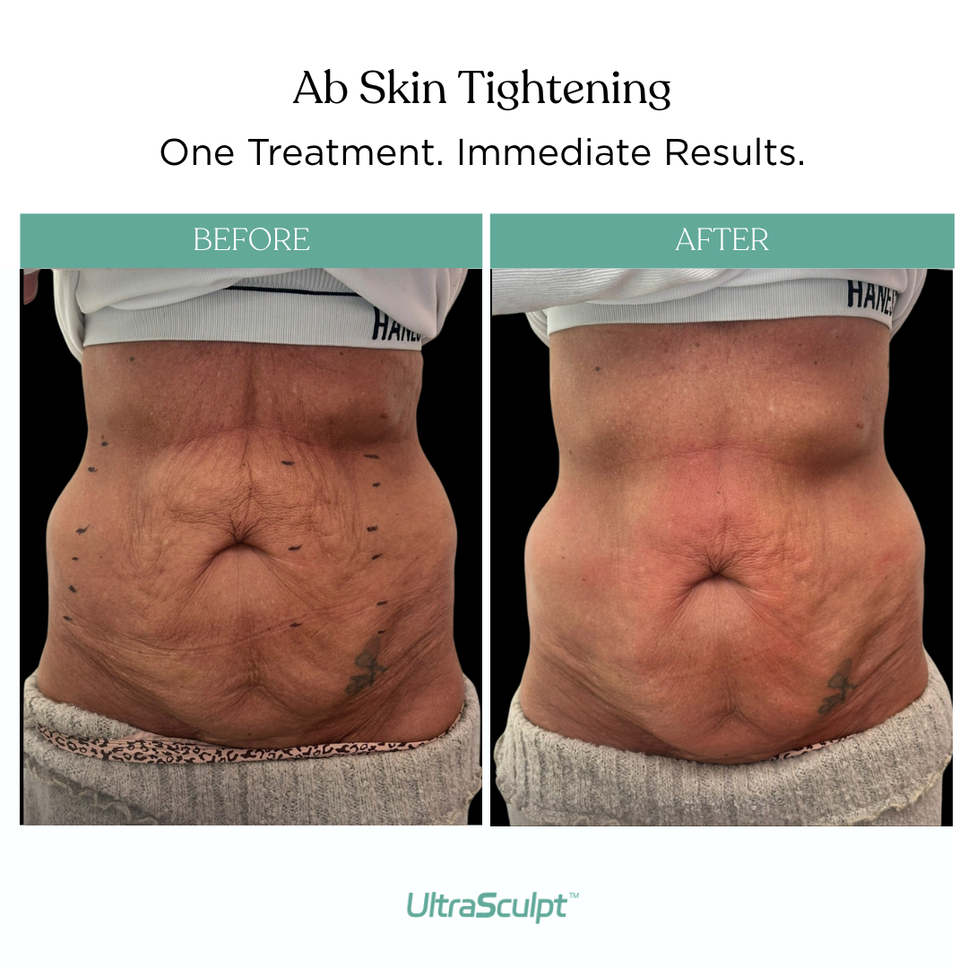 Abdomen — before