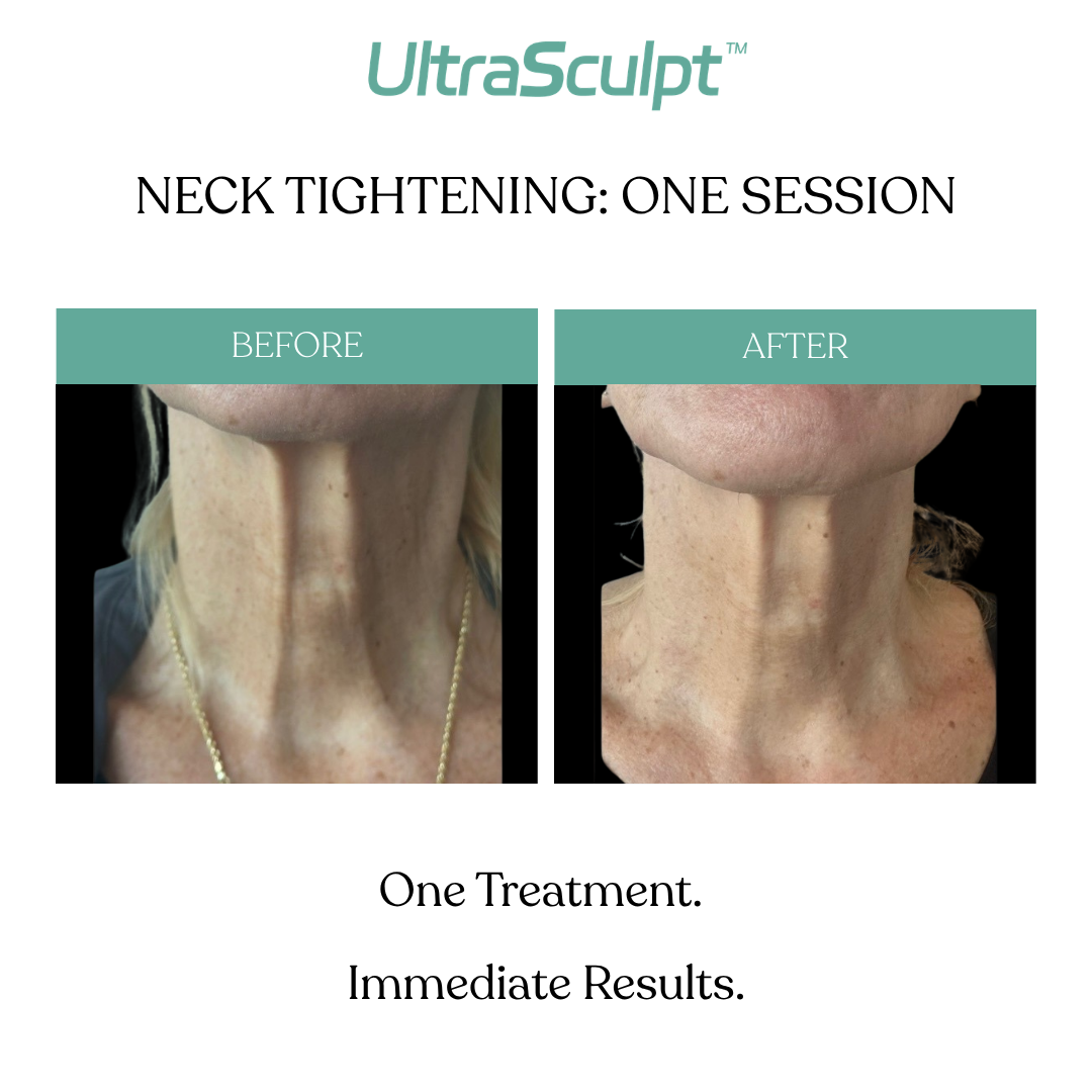 Original UltraSculpt neck before-and-after comparison labeled neck tightening: one session