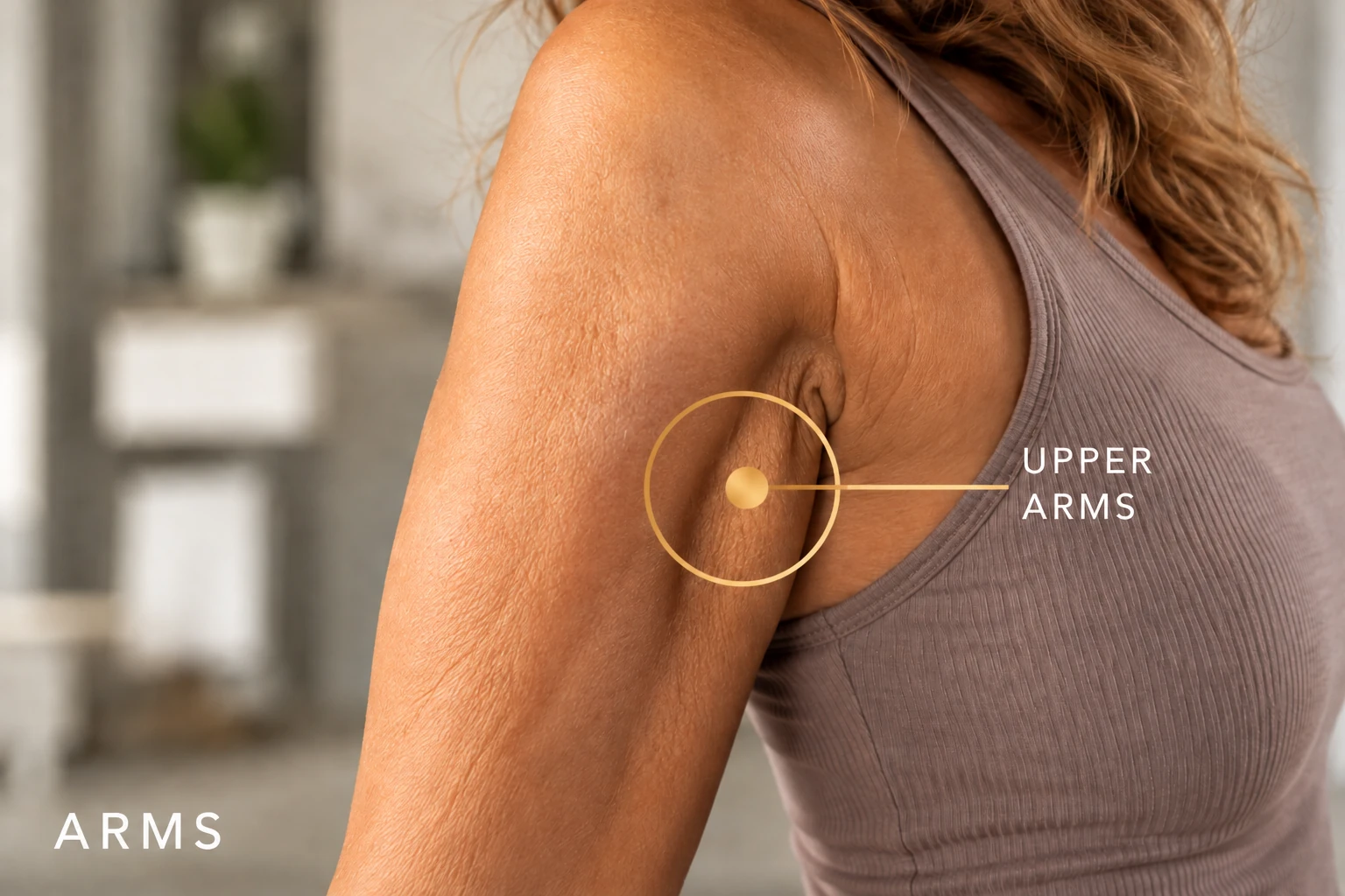 Upper Arms — illustrative treatment-area guide
